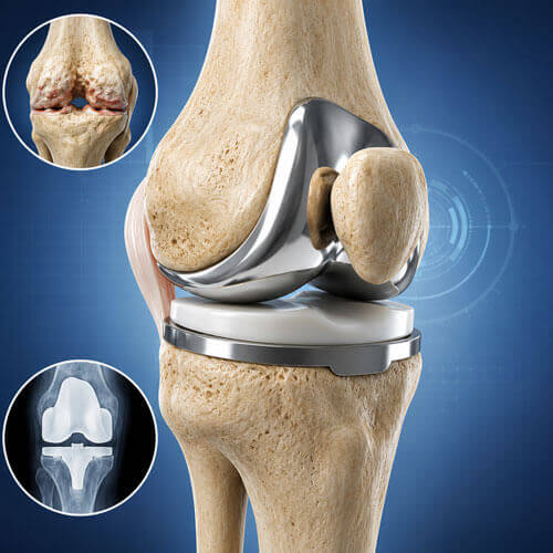 Total Knee Replacement (TKR)