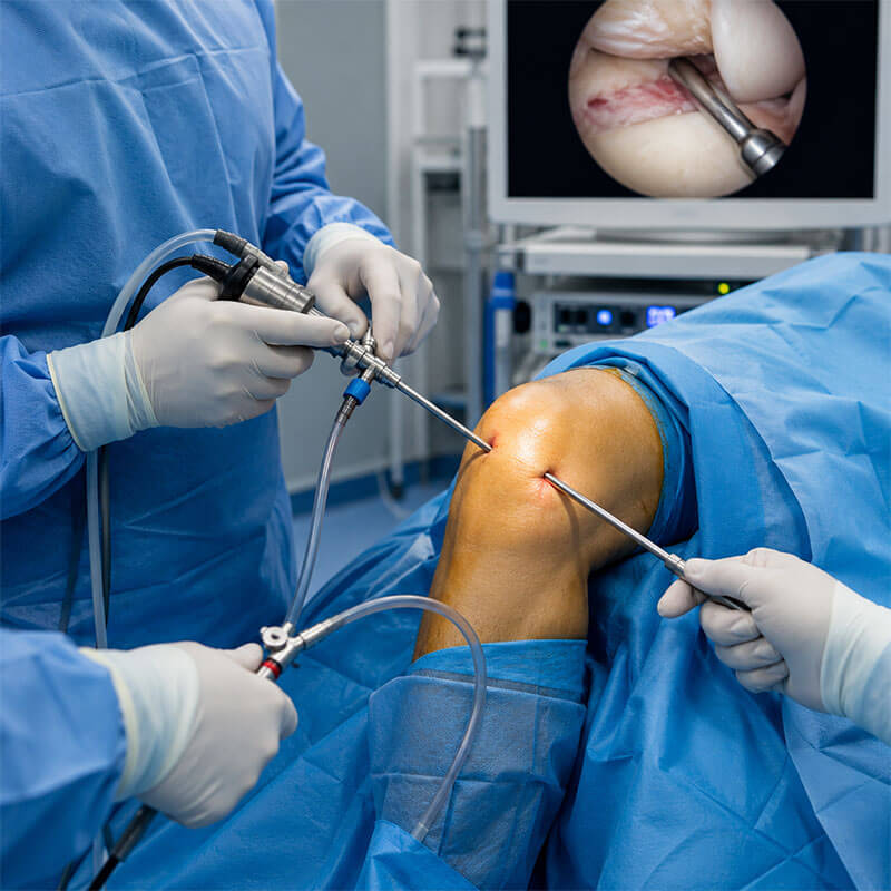 Knee Arthroscopy