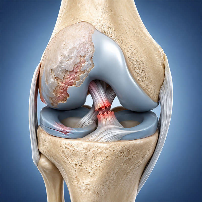 ACL Reconstruction