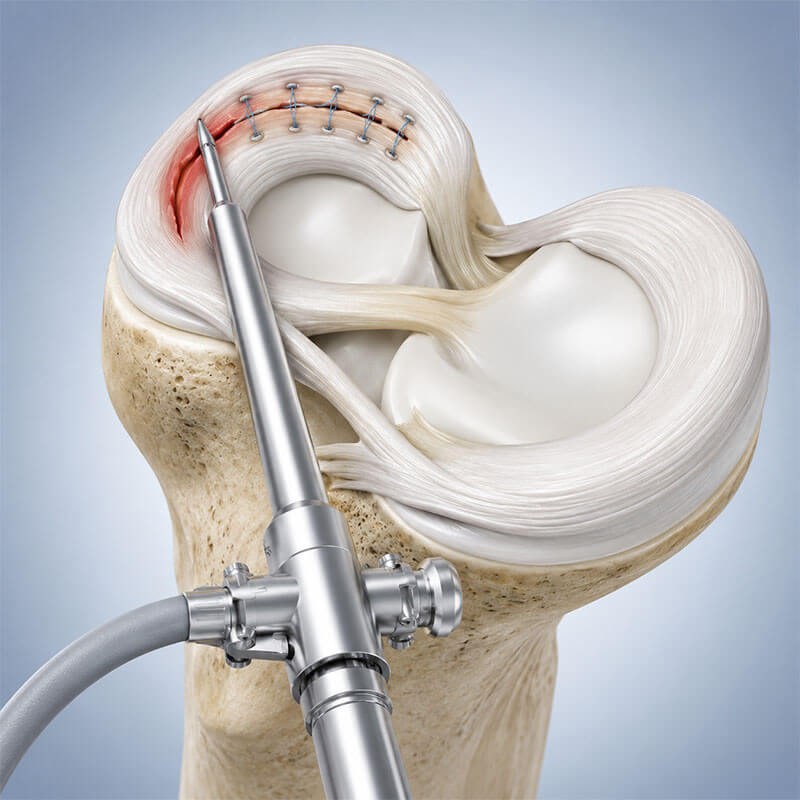 Meniscus Repair