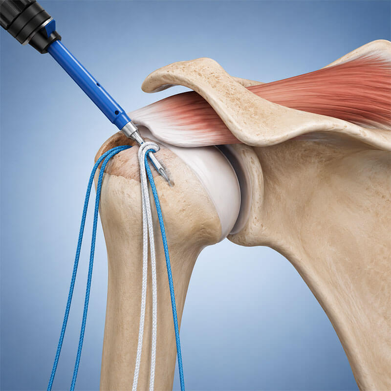 Rotator Cuff Repair